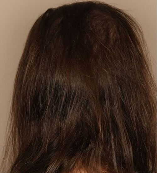 I stopped hair loss with Verdexedil