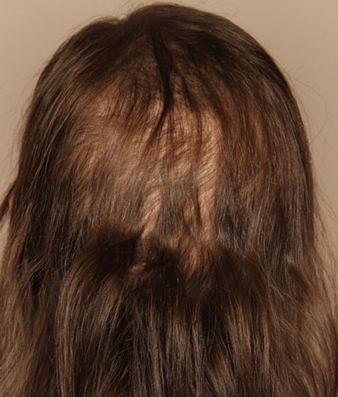 hair loss before using the Verdexedil spray